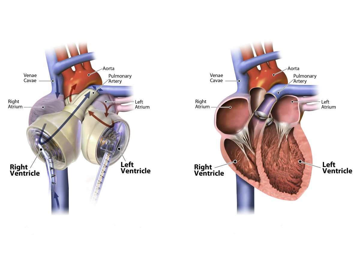 UCLA faculty voice: Current artificial hearts are too big for too